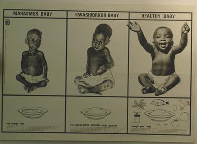 National Food and Nutrition poster with images and descriptions of 'Marasmus Baby, not enough food,' 'Kwashiorkor Baby, not enough Body-Building foods,' and 'Healthy Baby, enough good foods'